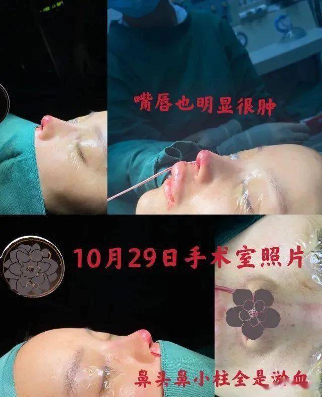 张檬整容前后对比_娱乐圈没整过容的明星_整容毁掉事业的女明星